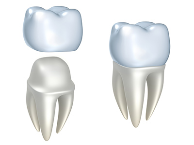 Rendering of dental crown at Reich Dental Center – Roswell.