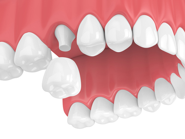 Rendering of jaw with dental crown done at Reich Dental Center.