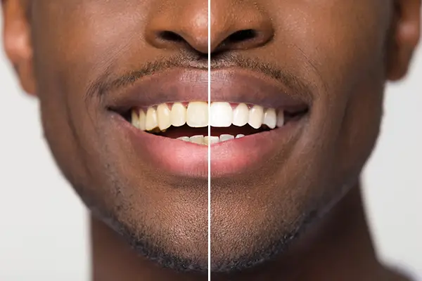 Close up comparison of before and after teeth whitening treatment